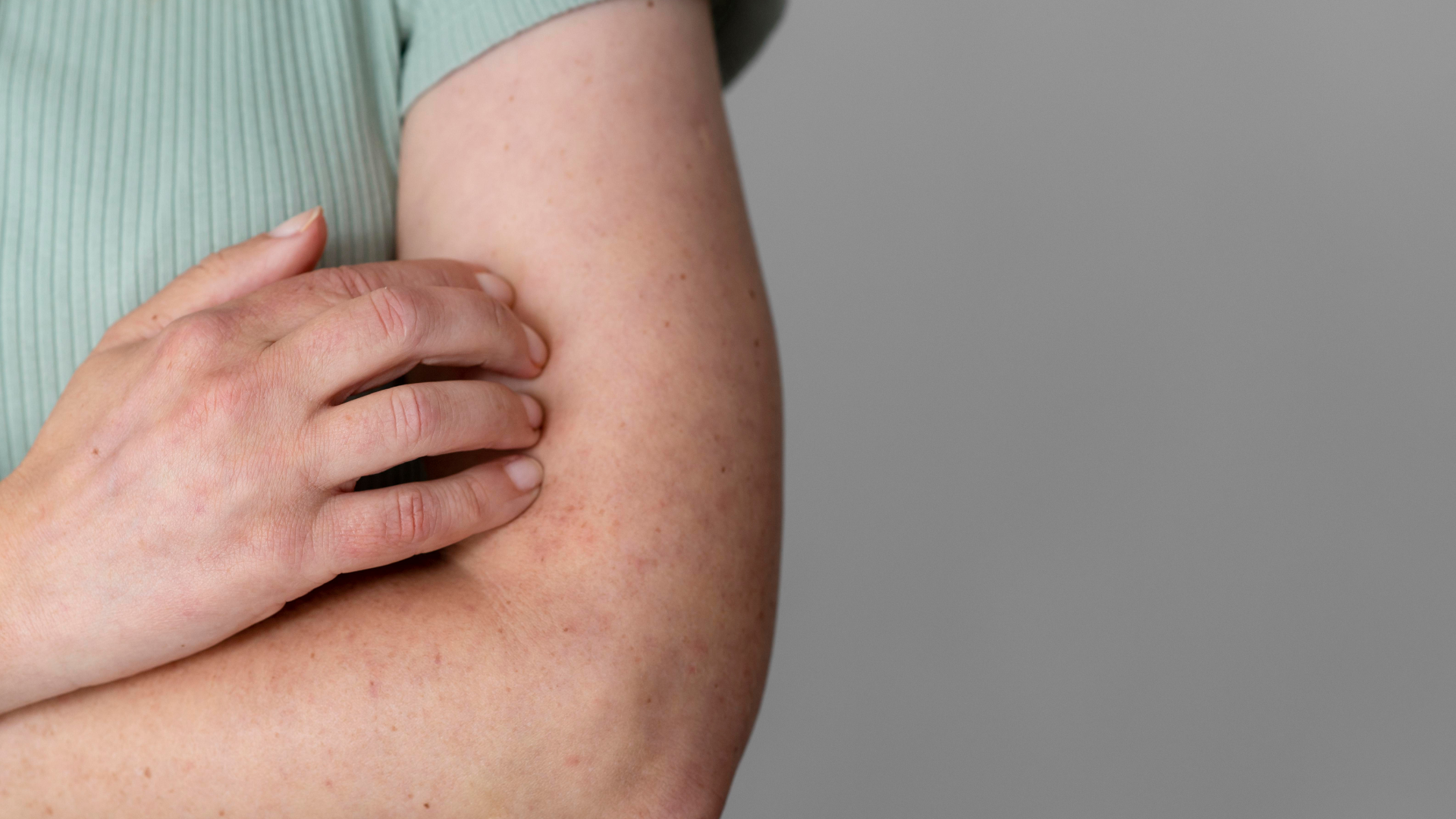 Actualización sobre sarampión 